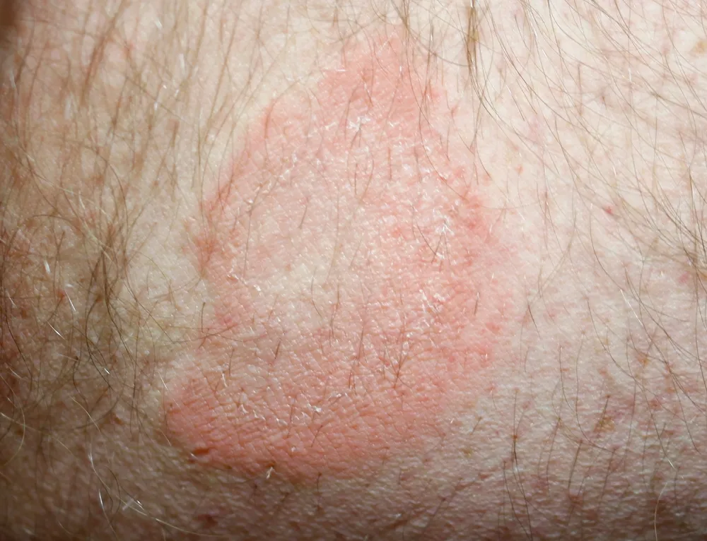 U hạt vòng granuloma annulare