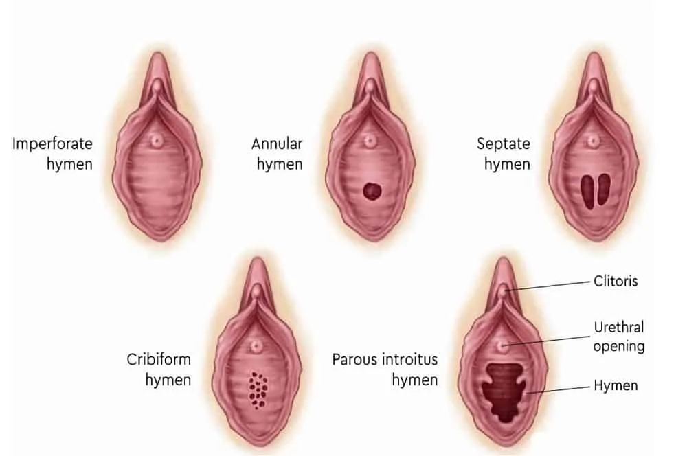 Màng trinh nằm ở vị trí nào và các loại màng trinh
