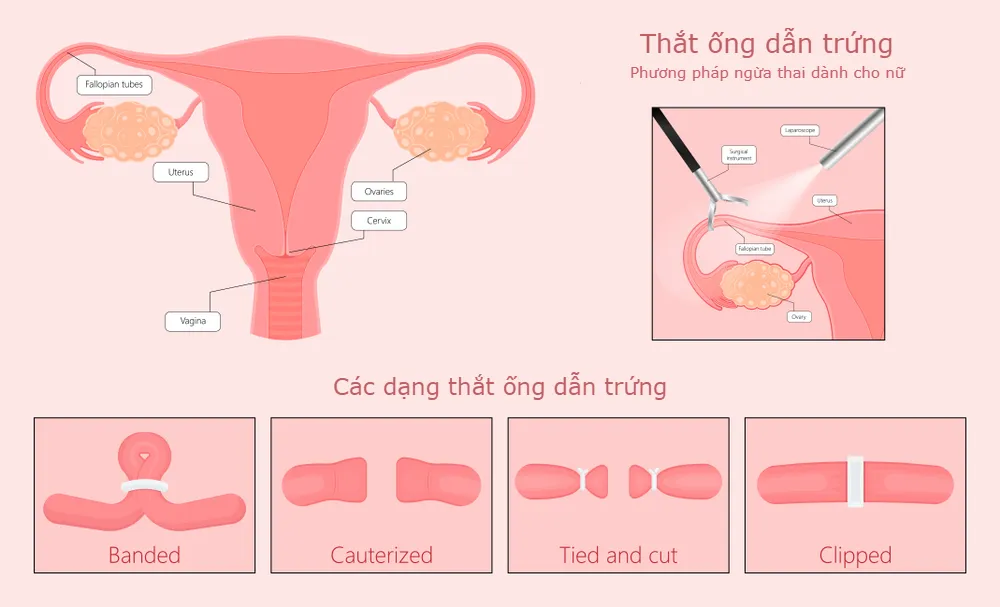 thắt ống dẫn trứng bao lâu thì quan hệ được