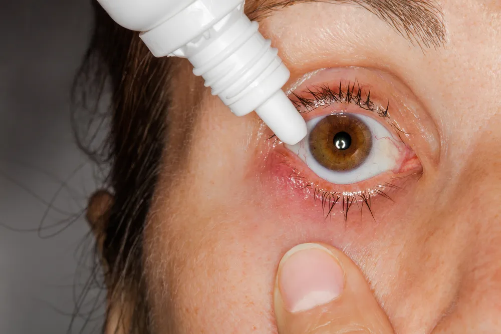 thuốc nhỏ mắt trị lẹo