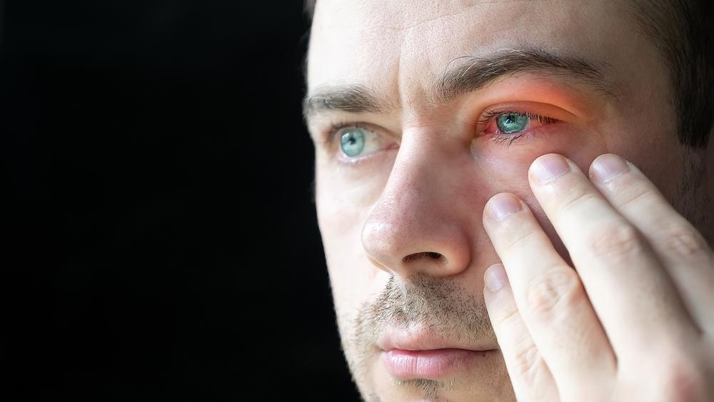 triệu chứng nhiễm virus viêm kết mạc