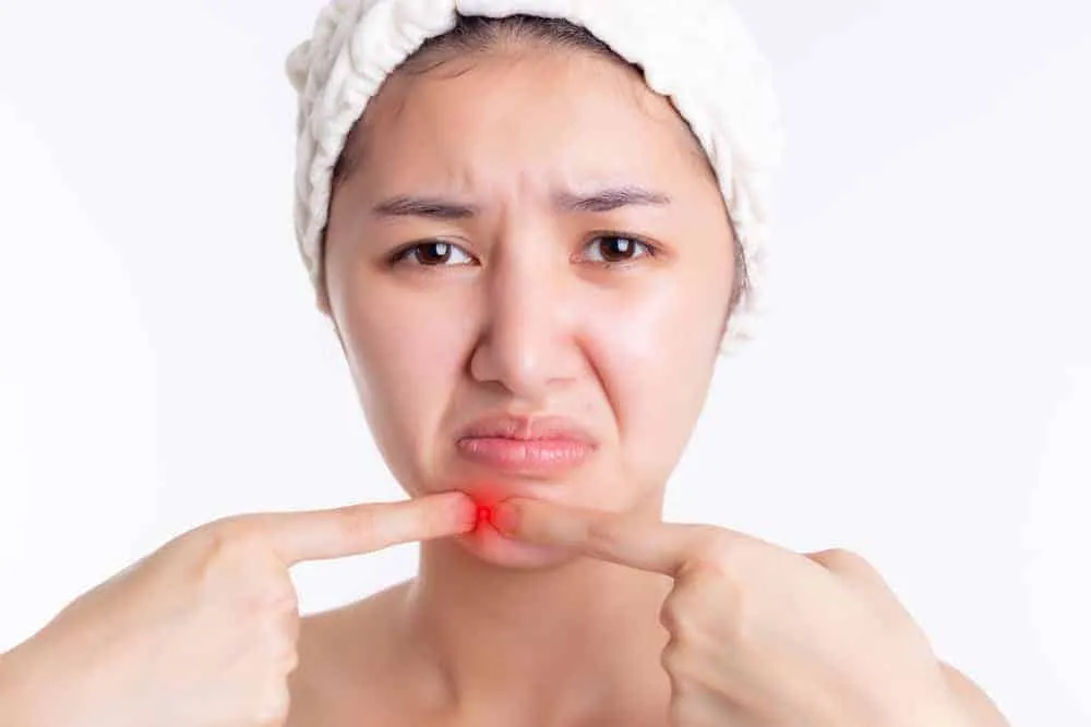 có nên đi nặn mụn ở spa 