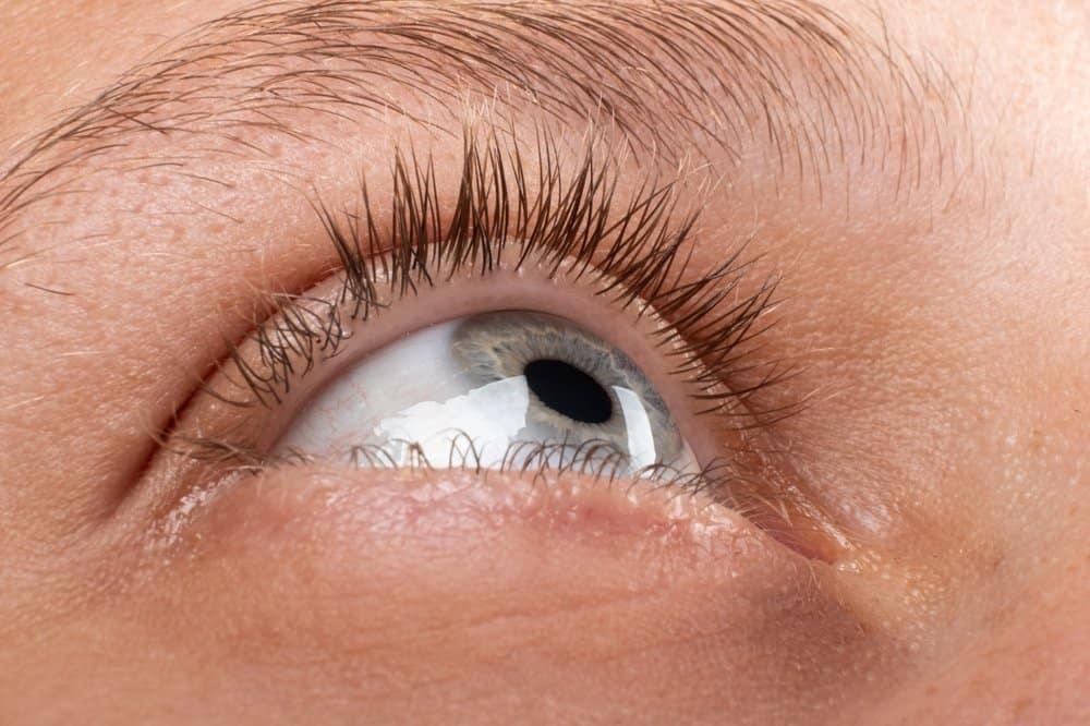 hậu quả nghiêm trọng nhất của bệnh đau mắt hột là lông mi mọc ngược