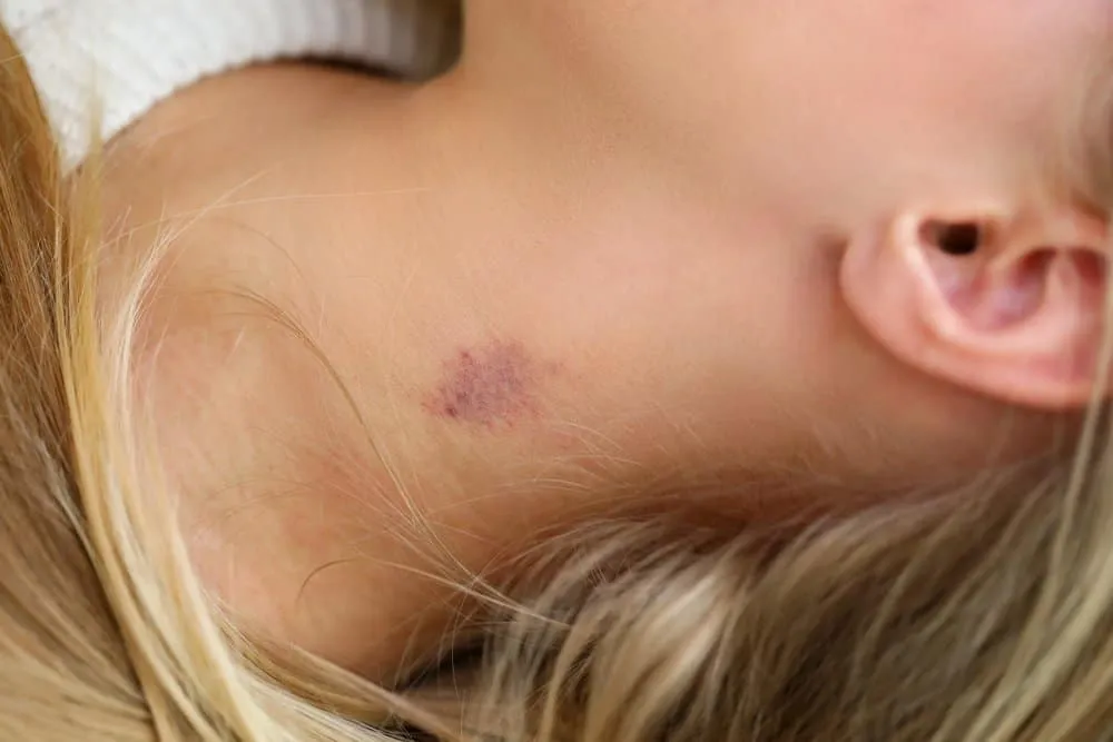 Vết cắn yêu hickey có nguy hiểm không?