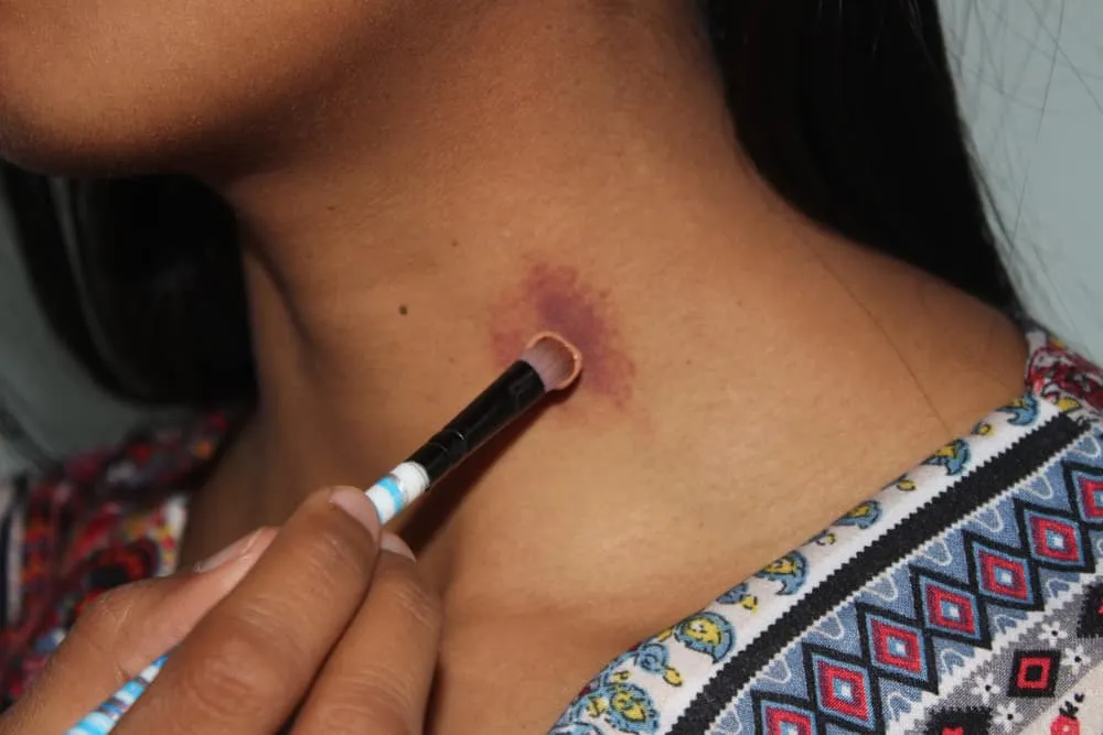 Hickey có nguy hiểm không?