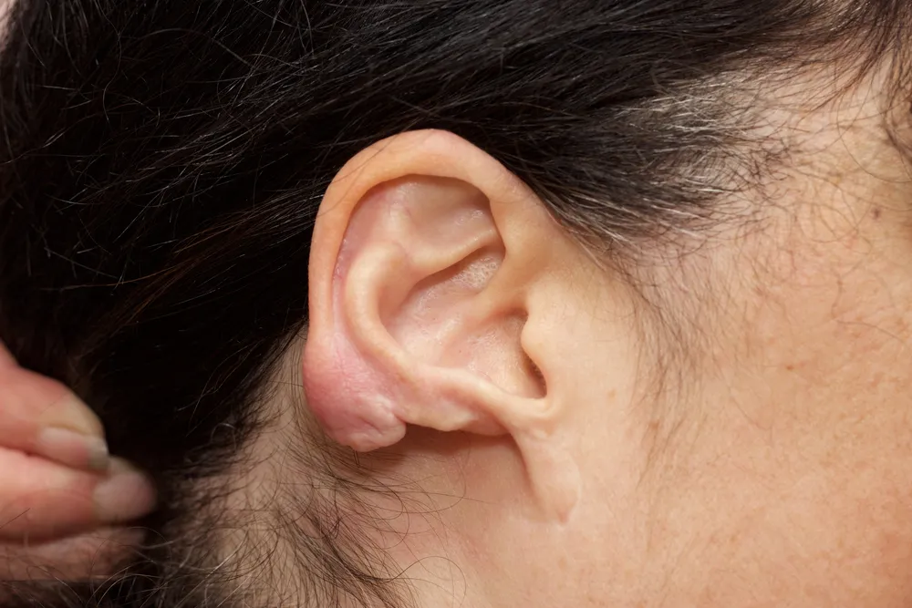 sẹo lồi ở tai