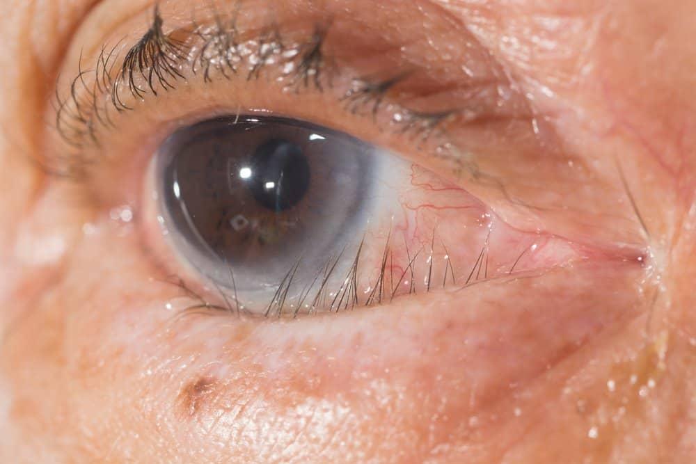 triệu chứng đau mắt hột là lông mi mọc ngược