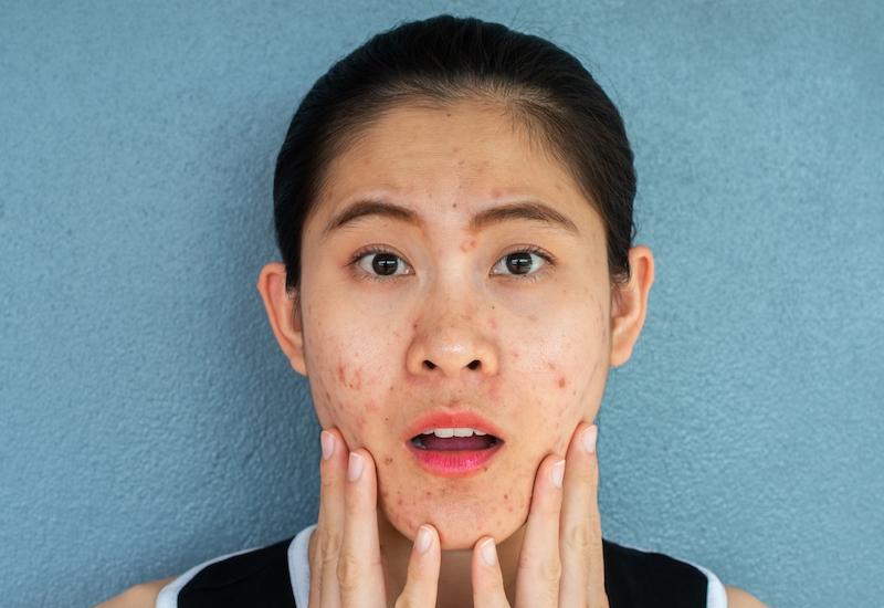 uống cà phê có nổi mụn không