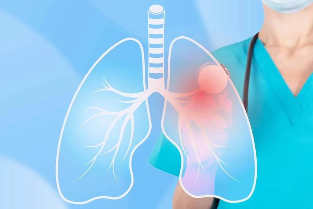 Các giai đoạn của lao phổi: lao tiềm ẩn