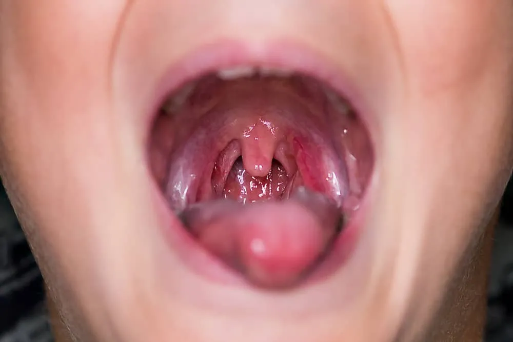 hậu quả sau khi cắt amidan