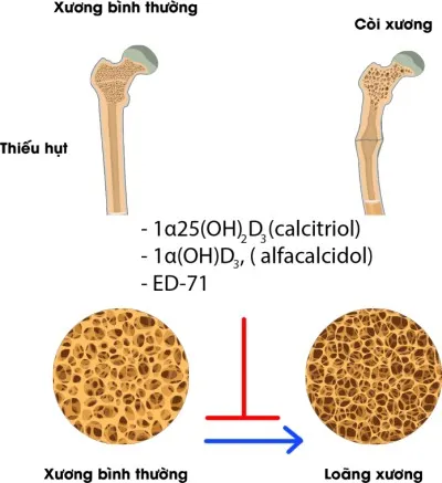 nguyên nhân của bệnh loãng xương ở người già