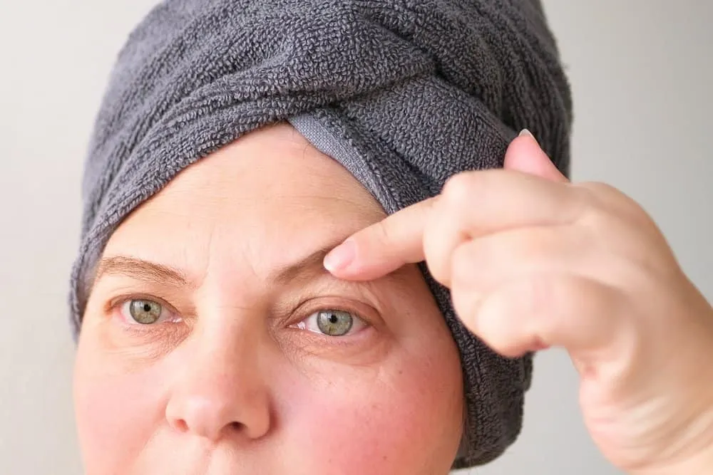 nguyên nhân sụp mí mắt do lão hóa