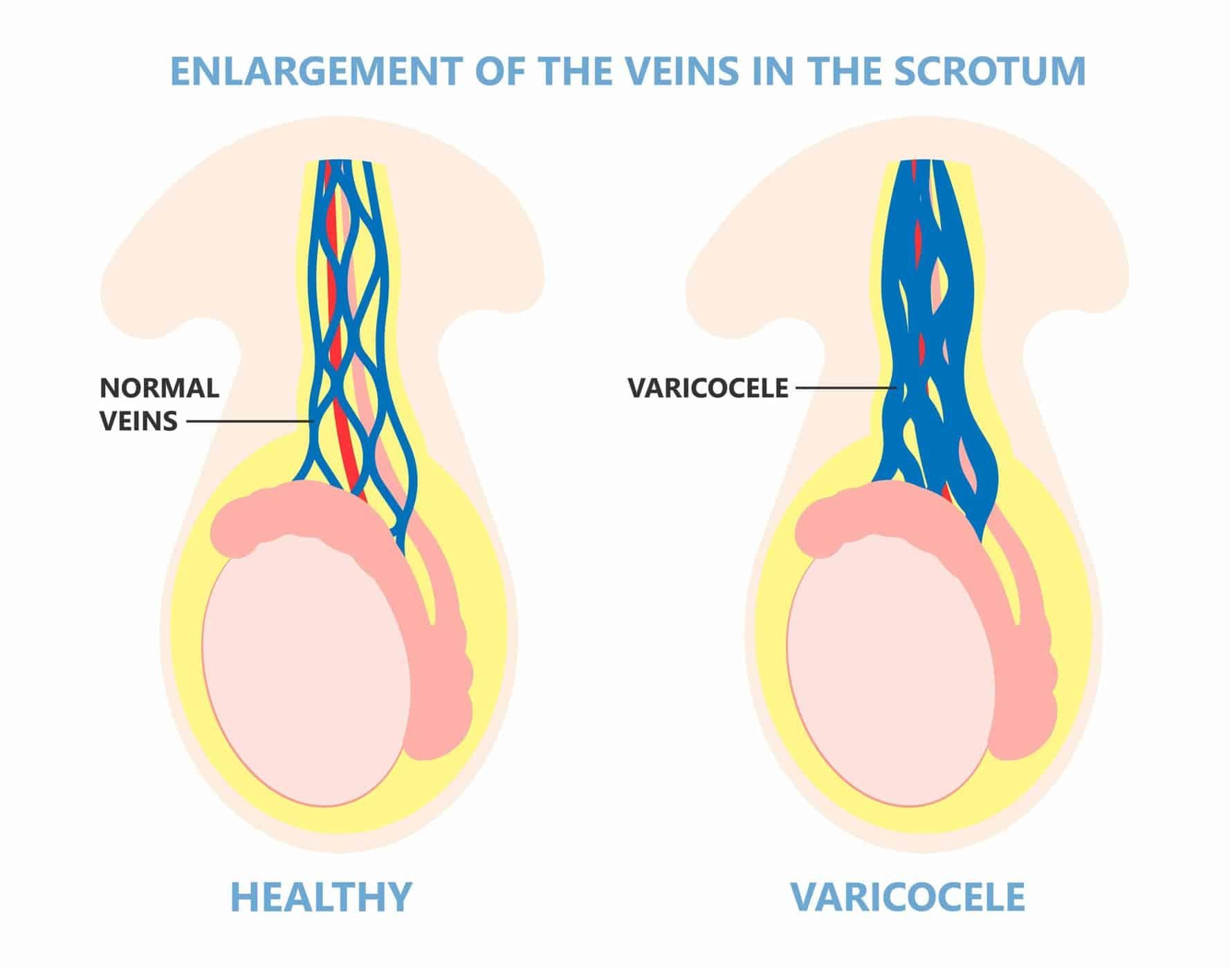 bệnh sa bìu ở nam giới