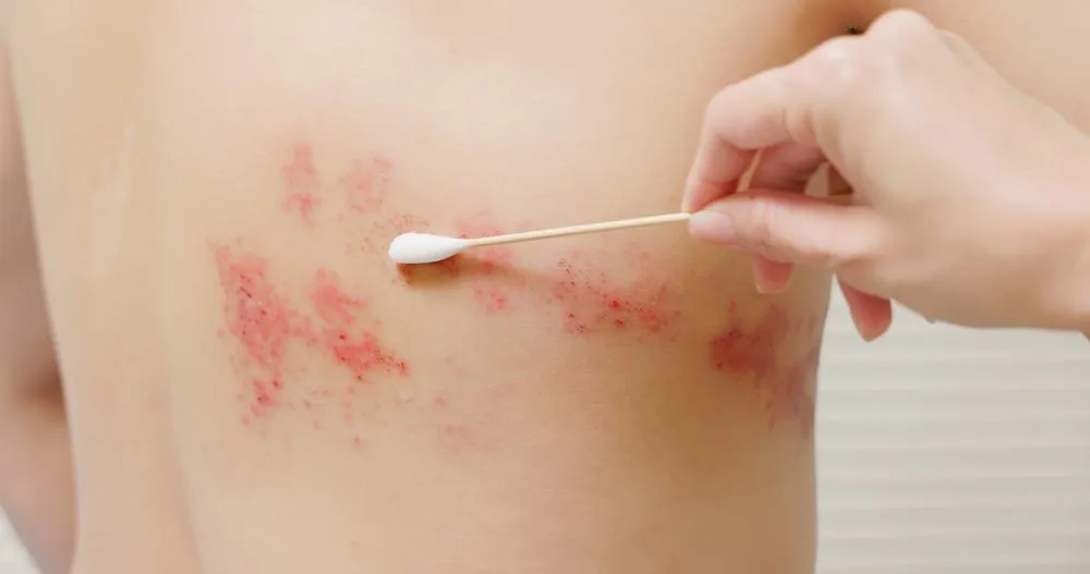 Bệnh zona thần kinh kiêng gì và nên làm gì