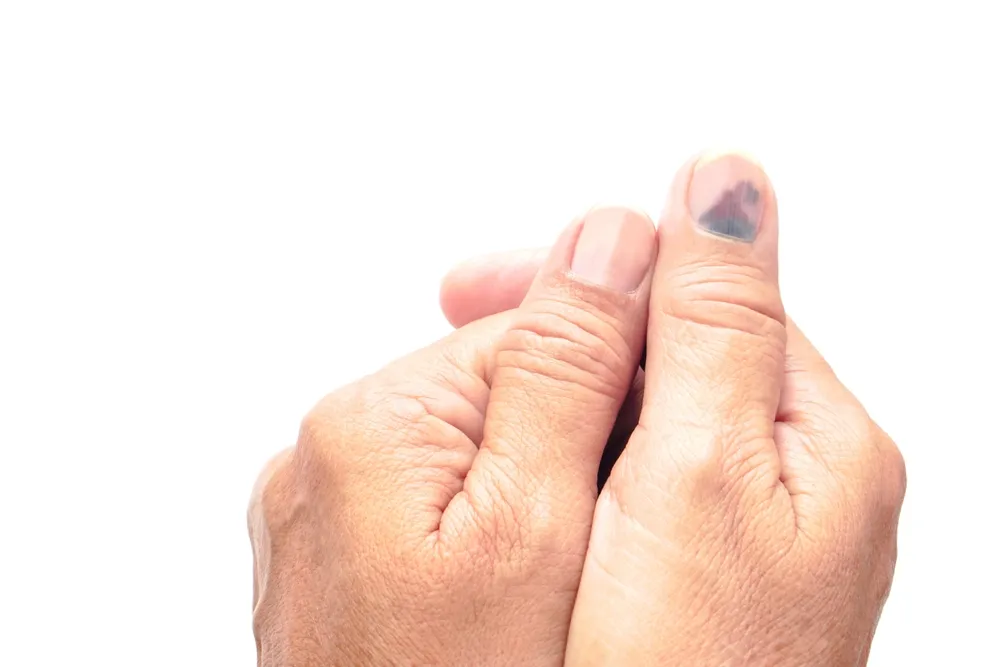 Vấn đề về móng tay: Tụ máu dưới móng tay