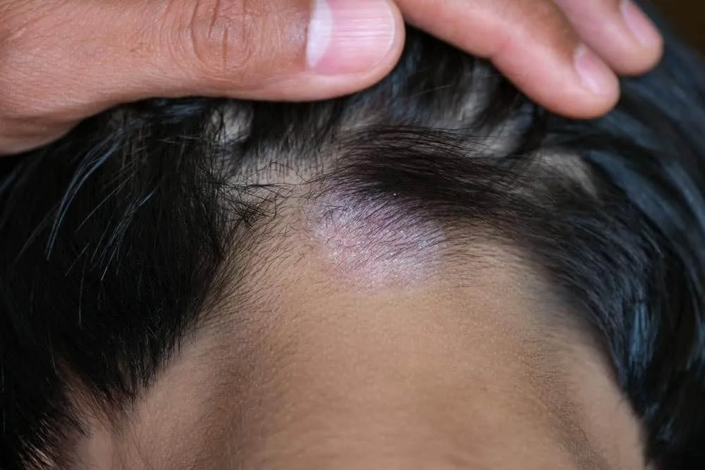 Bệnh nấm da đầu