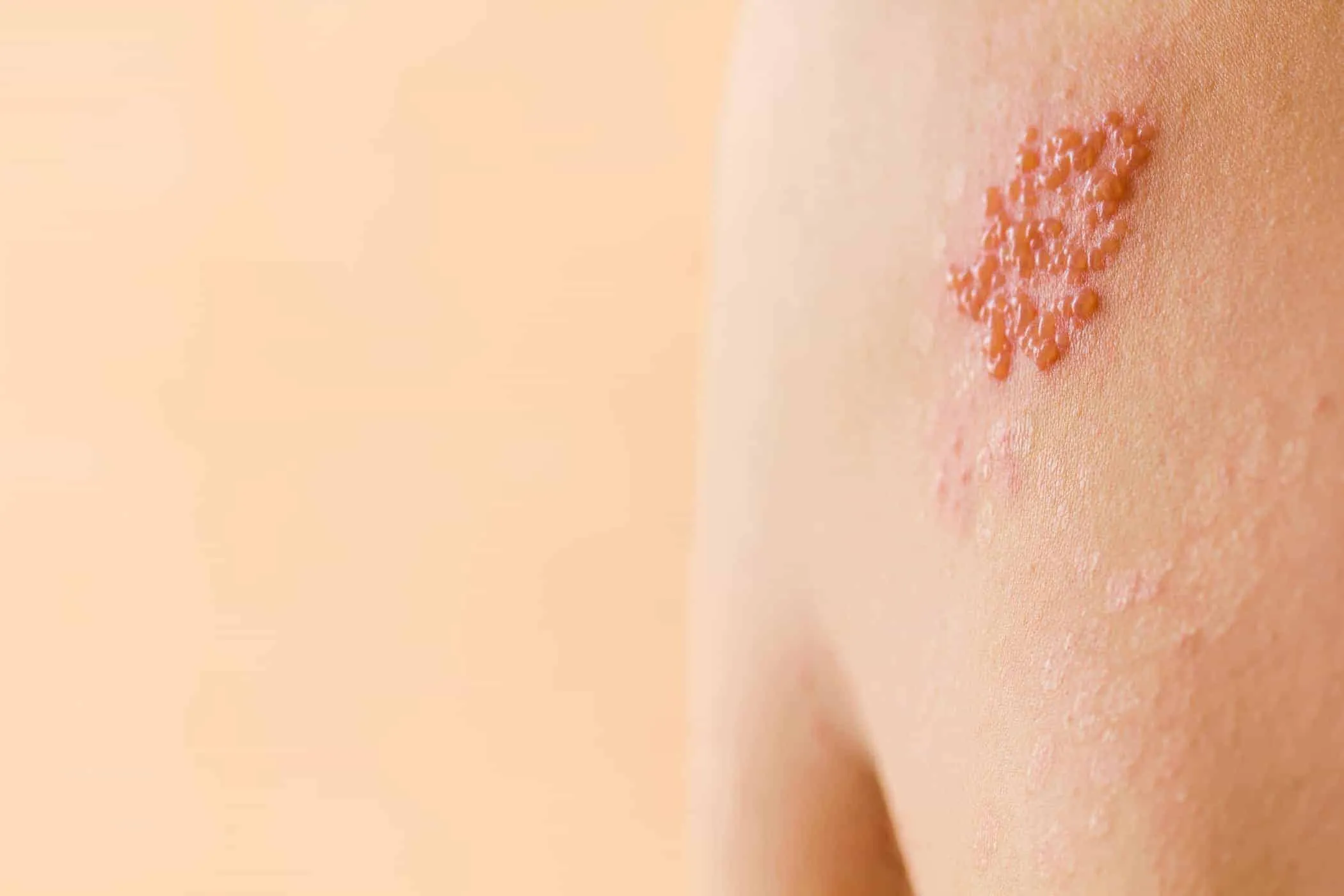 Nguyên nhân gây bệnh zona thần kinh và các yếu tố nguy cơ