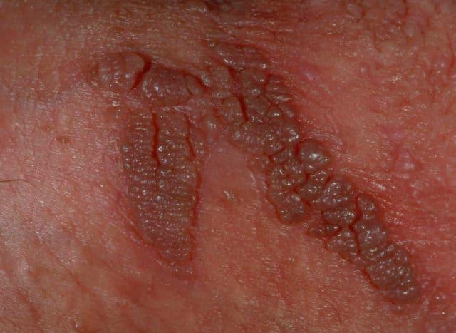 sùi mào gà âm đạo