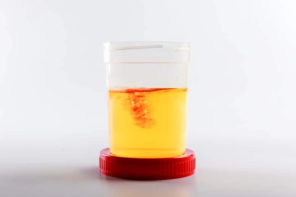 Đi tiểu ra máu ở nữ là gì