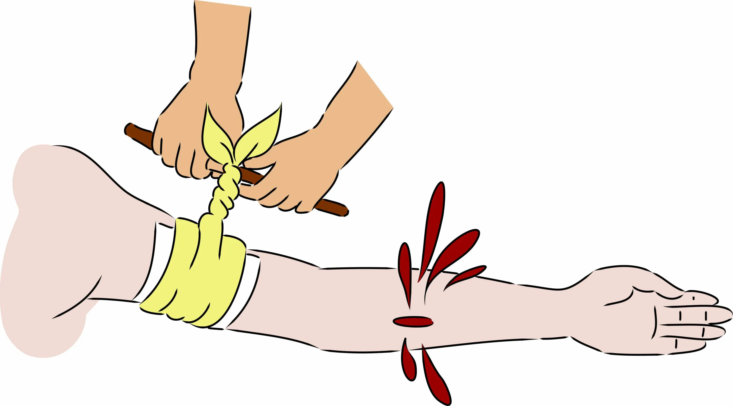 Cầm máu bằng phương pháp ga-ro khi bị đứt tay chảy máu nhiều