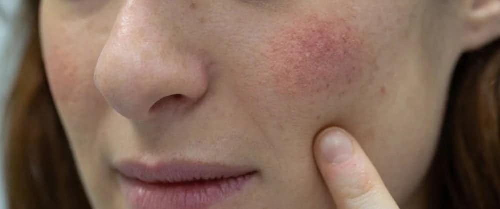 thải độc da nhiễm corticoid