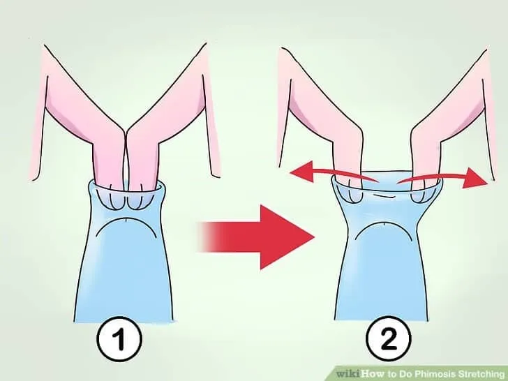 Cách lột bao quy đầu tại nhà cho người lớn - Giai đoạn 3