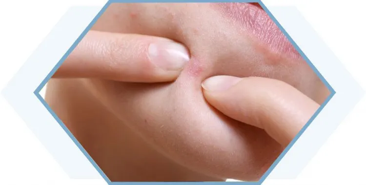 tình trạng mụn dưới cằm