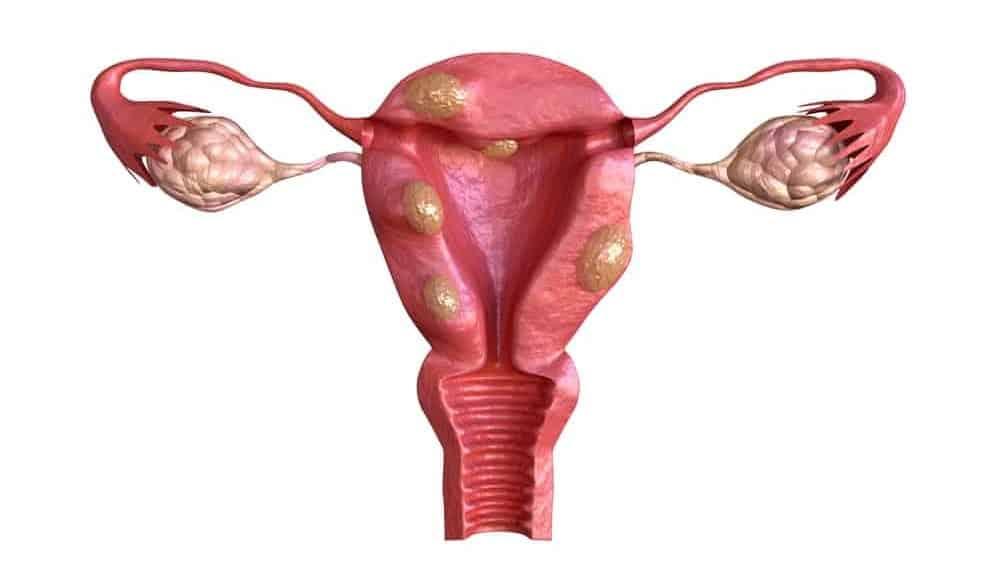 Bị đau lưng dưới ở nữ u xơ tử cung