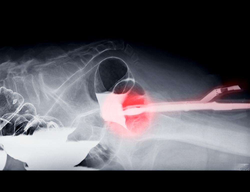 chẩn đoán viêm túi thừa đại tràng