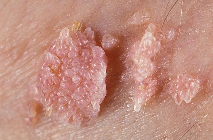 dấu hiệu sùi mào gà ở nữ