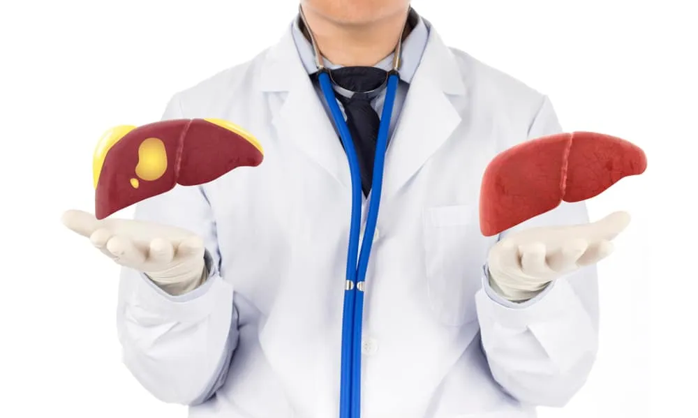 bệnh gan nhiễm mỡ độ 1