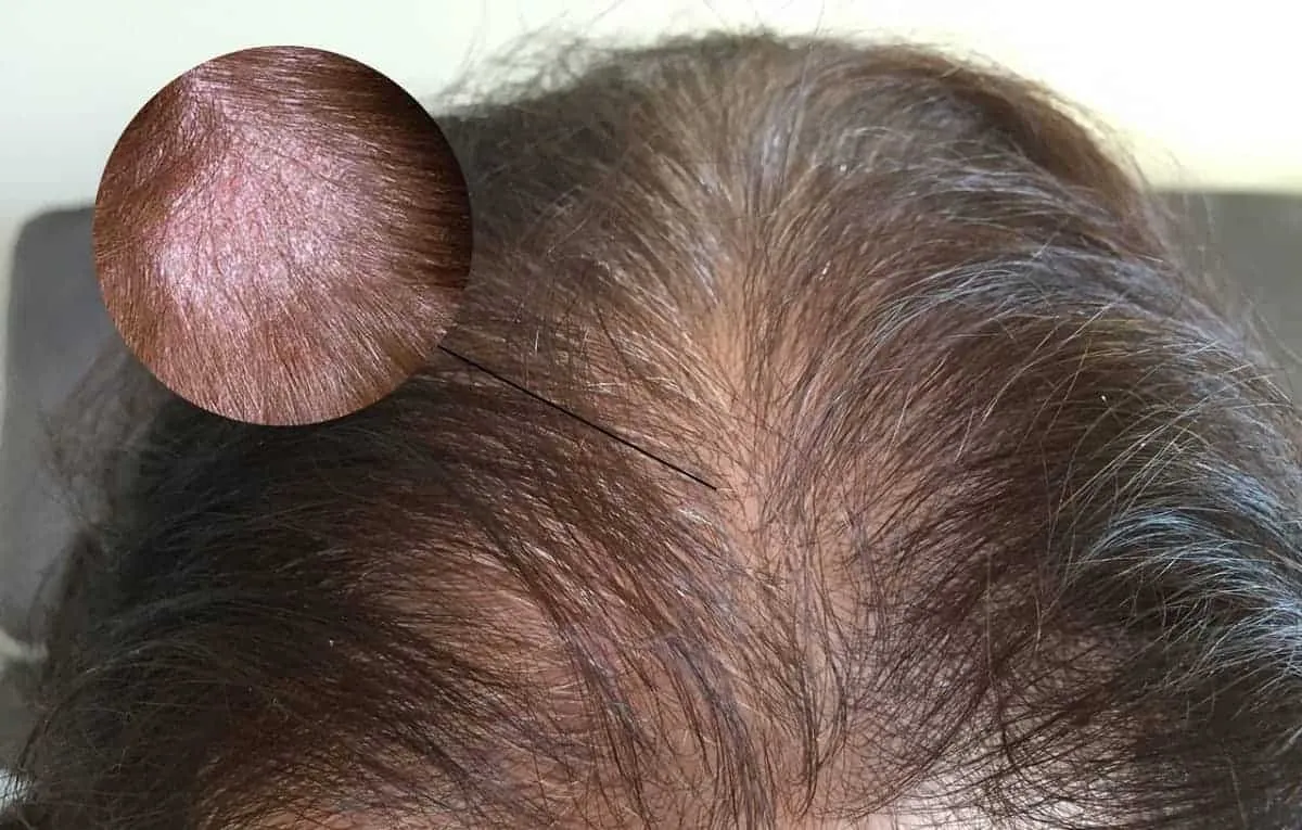 các loại nấm da: Nấm da đầu