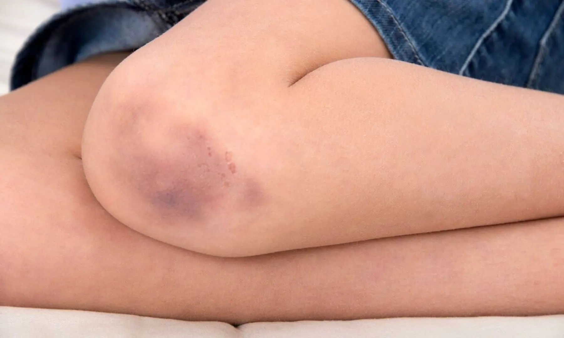 Vết bầm tím kéo dài bao lâu