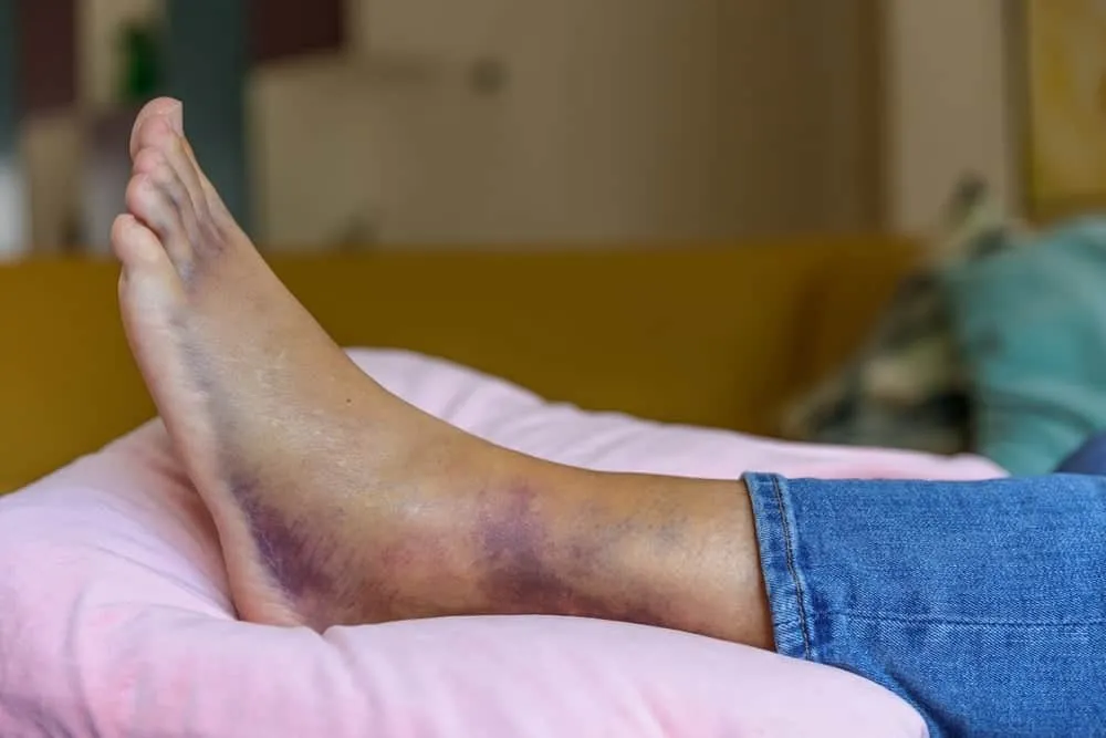 Nâng vùng bị thương lên cao