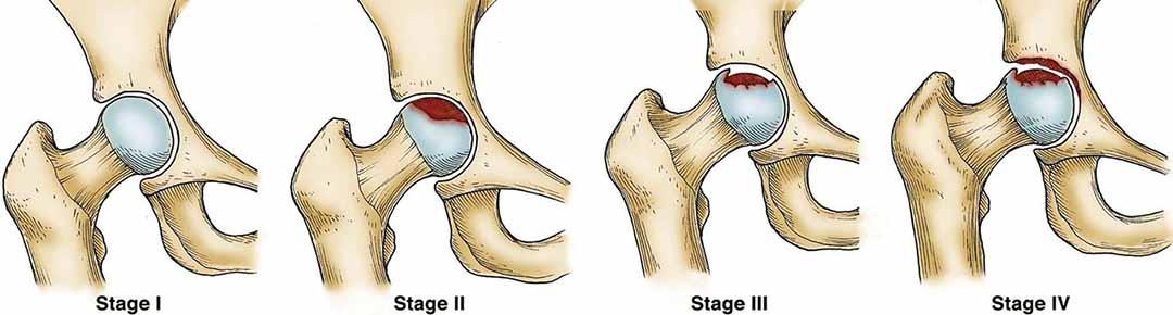 diễn tiến hoại tử chỏm xương đùi