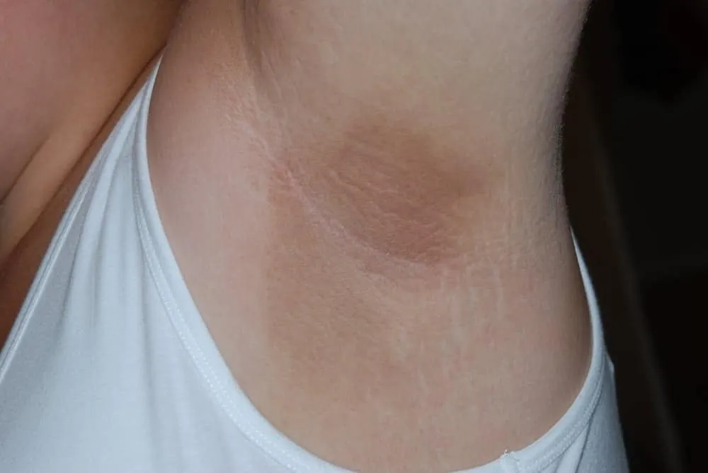 triệu chứng tiền tiểu đường