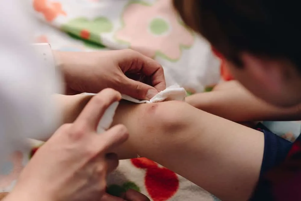 cách làm tan vết bầm cho trẻ