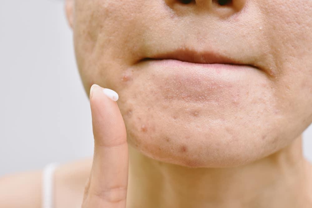 cách sử dụng Klenzit Ms và Klenzit C