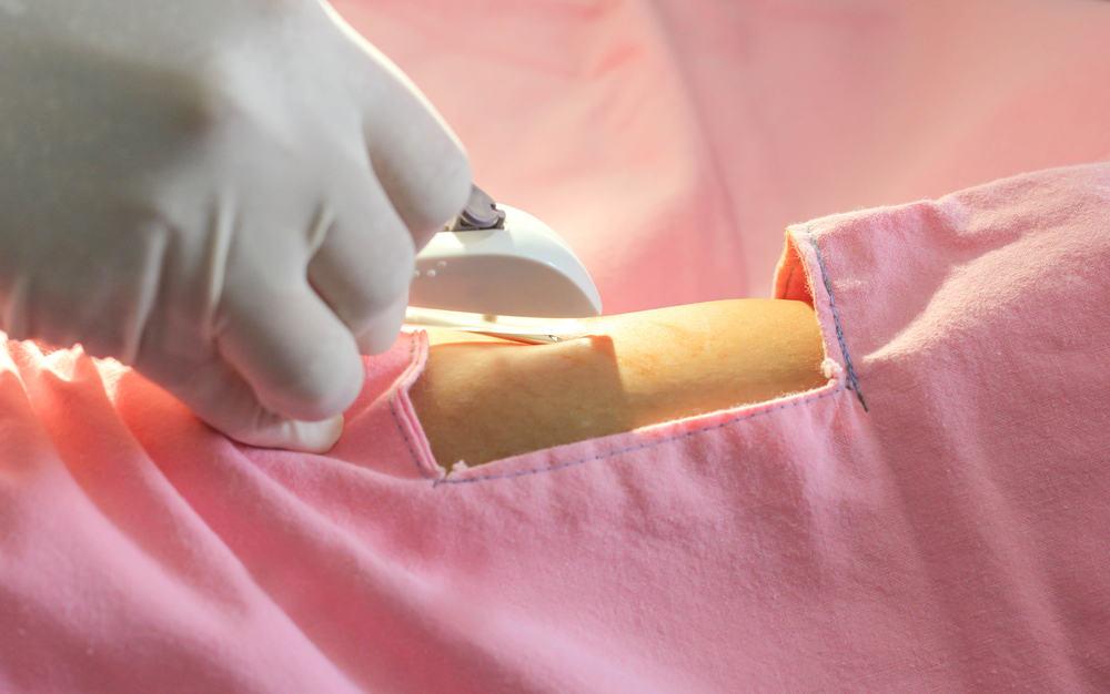 cấy que tránh thai