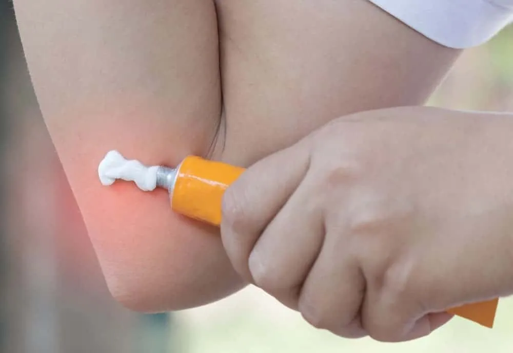 điều trị viêm da cơ địa bằng thuốc bôi 