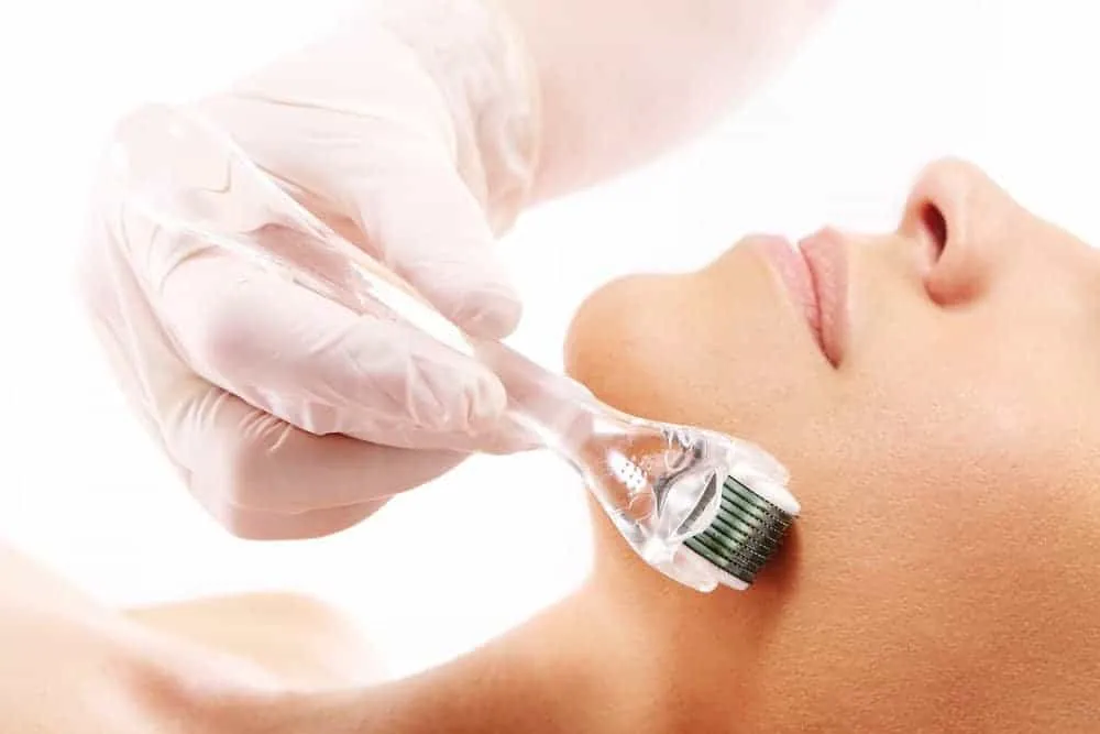 cách trị sẹo rỗ bằng lăn kim