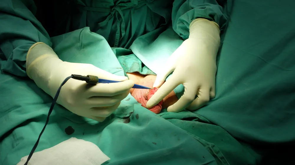 hẹp bao quy đầu ở người lớn: Phẫu thuật cắt bao quy đầu