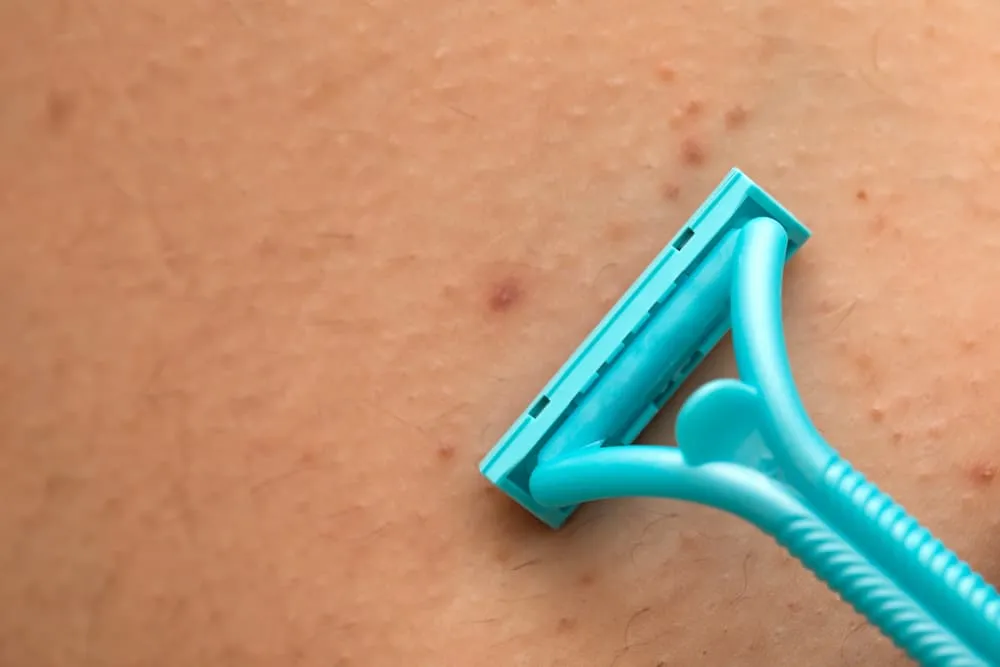 viêm nang lông nách