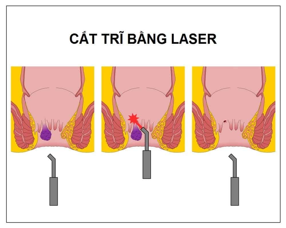 cắt trĩ bằng laser