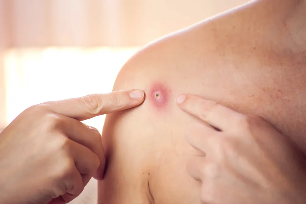 triệu chứng nhiễm khuẩn tụ cầu vàng