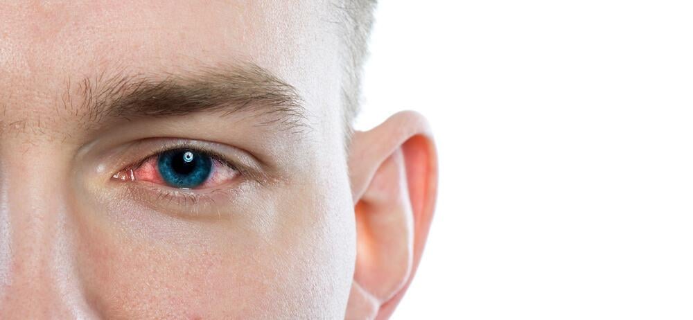 bệnh đau mắt đỏ có lây không