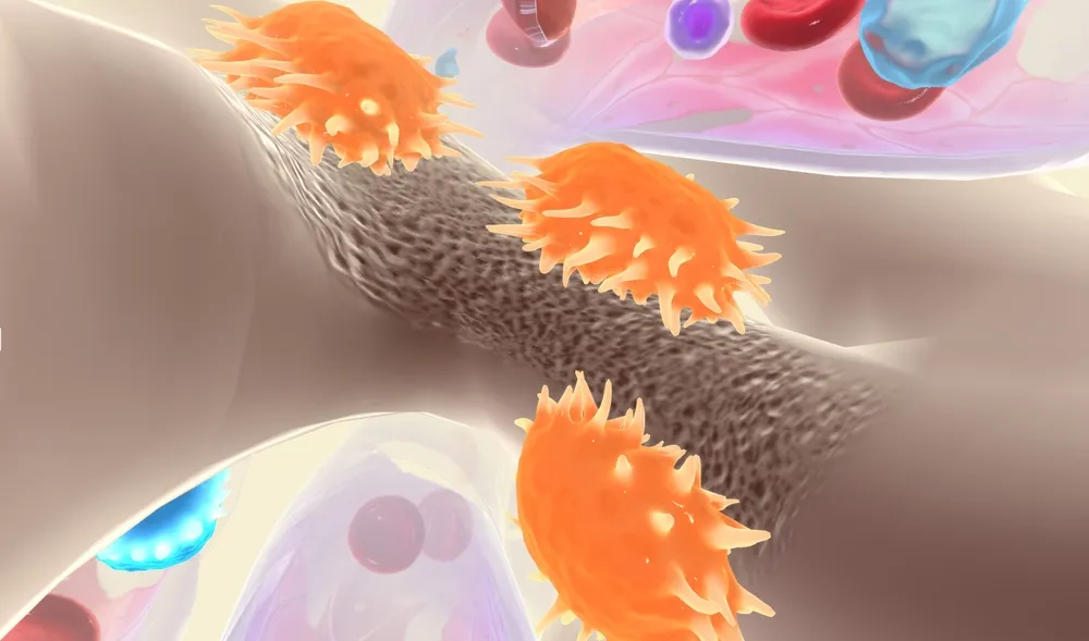 ung thư di căn xương sống được bao lâu tùy loại ung thư nguyên phát