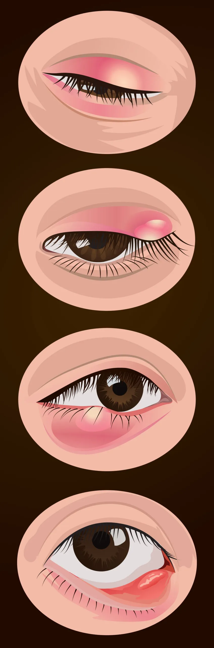 chớp mắt thấy đau do chắp lẹo