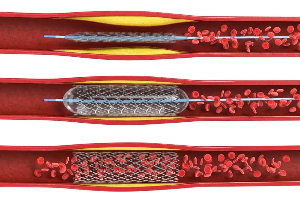 đặt stent loại nào
