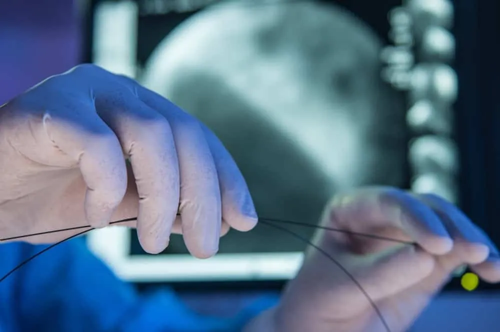 quy trình đặt stent